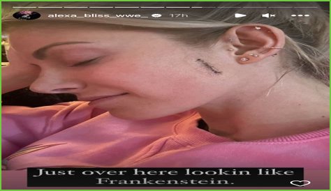 WWE's Alexa Bliss posts photo of stitches from skin cancer surgery